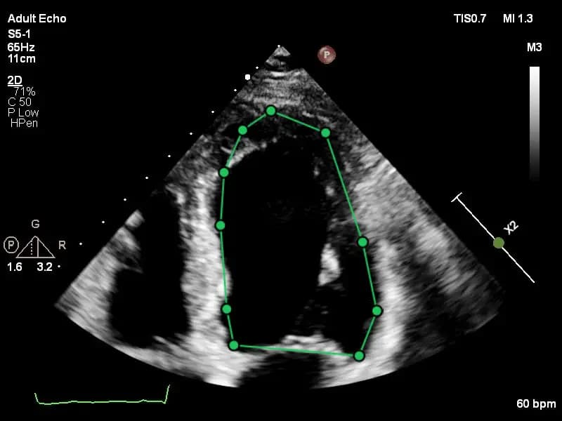 LV Diastolic Volume 4 Chamber