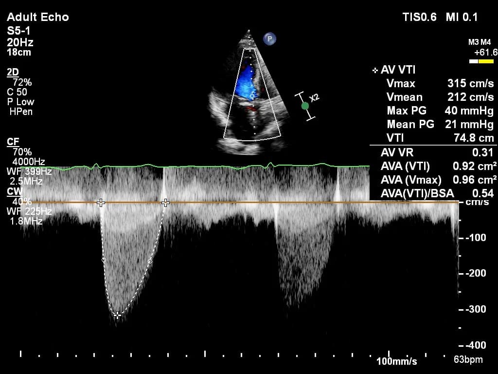 Aortic valve VTI doppler