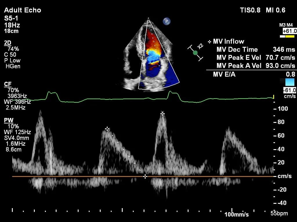 Mitral valve inflow doppler
